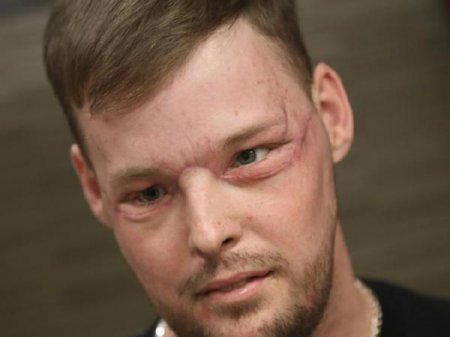 Американцу успешно пересадили лицо спустя 10 лет после того, как он изуродовал свое, выстрелив себе в подбородок из ружья (фото, видео)