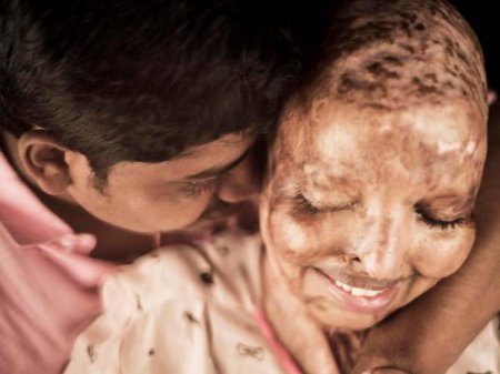 Индианка, которую изуродовали кислотой десять лет назад, нашла свою любовь и выходит замуж (фото)