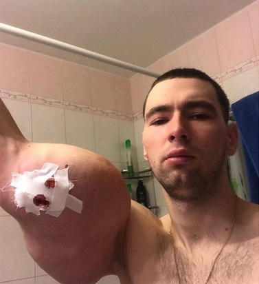 Не понимал, что делает: хирурги рассказали сенсационную правду об известном блогере «Руки-базуки»