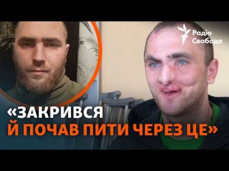 Втратив пів обличчя на війні, допомогли лікарі з Канади: історія військового з Волині